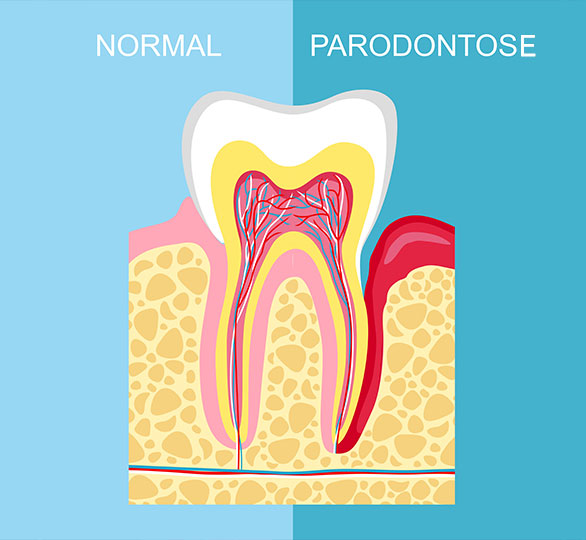 Parodontose-1